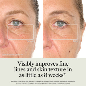Close-up comparison of a woman's eye area before and after 8 weeks using TheraFace Mask Glo | Therabody, showing reduced fine lines and improved skin texture.