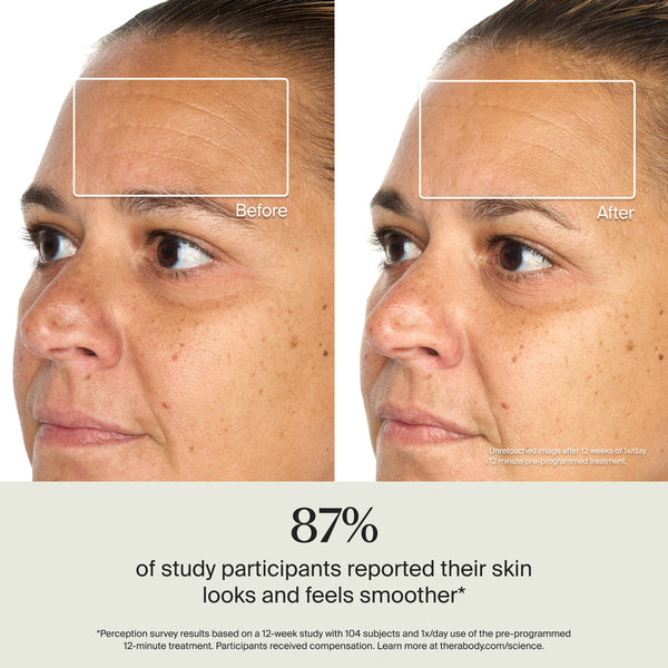 Side-by-side close-up images of a woman's forehead showing visible wrinkle reduction after treatment with TheraFace Mask Glo | Therabody, highlighting smoother skin texture.