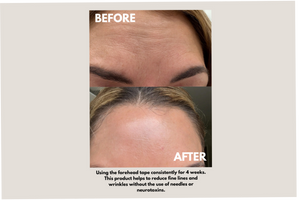 Before and after comparison showing reduced forehead wrinkles and smoother skin after using Forehead Tape – Wrinkle Smoothing Patches | Seald™ Wellness consistently for four weeks.