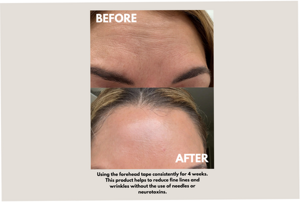 Before and after comparison showing reduced forehead wrinkles and smoother skin after using Forehead Tape – Wrinkle Smoothing Patches | Seald™ Wellness consistently for four weeks.